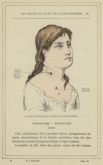 Accidents caractéristiques de la scrofulose à la période secondaire - French School
