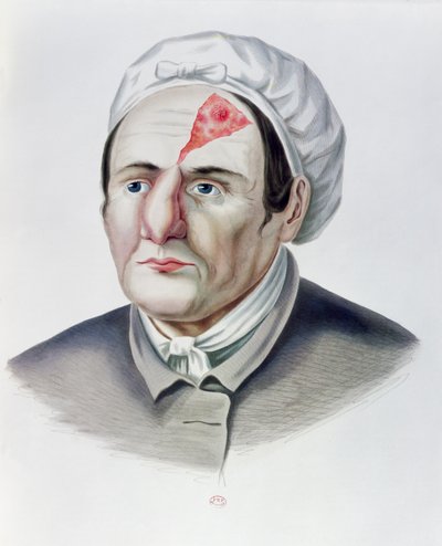 Après une opération de greffe de peau, de la Selecta Praxis Medico-Chirurgica par Alexander Auvert, Paris, 1856 - French School