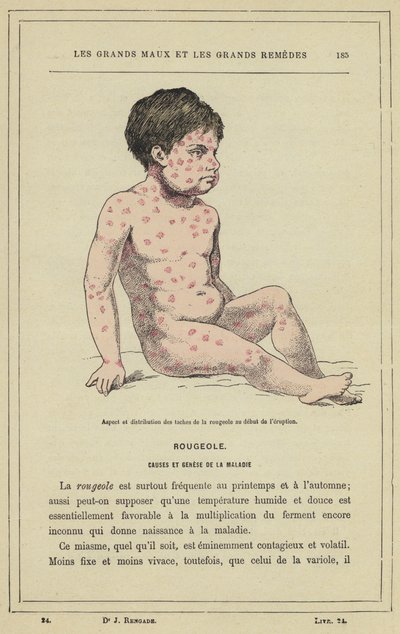 Aspect et distribution des taches de la rougeole au début de l