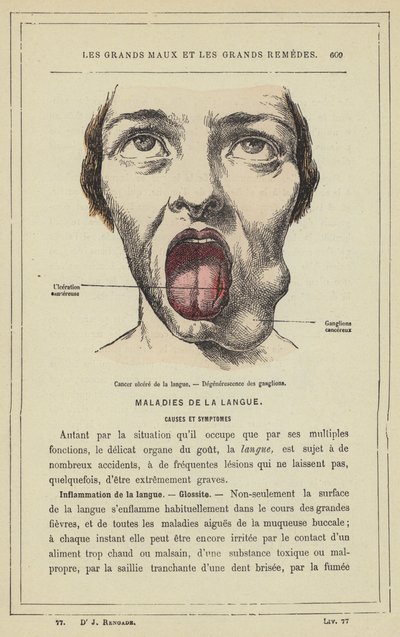 Cancer ulcéré de la langue, Dégénérescence des ganglions - French School