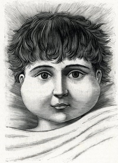 Enfant avec la maladie des oreillons (gravure) 1888 - French School