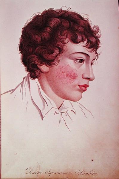 Tache sèche, de 