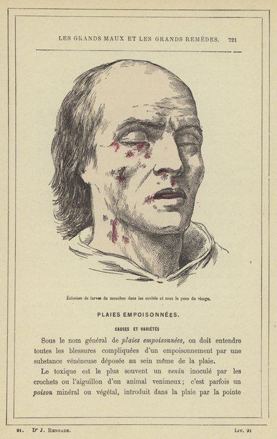 Éclosion de larves de mouches dans les cavités et sous la peau du visage - French School