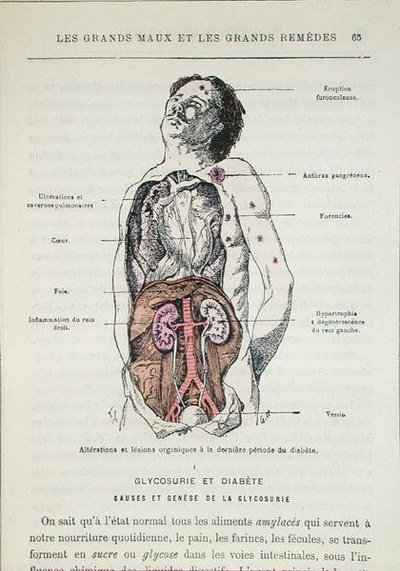 Effets du diabète, tiré de 