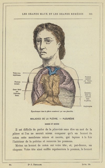 Épanchement dans la plèvre occasionné par une pleurésie - French School