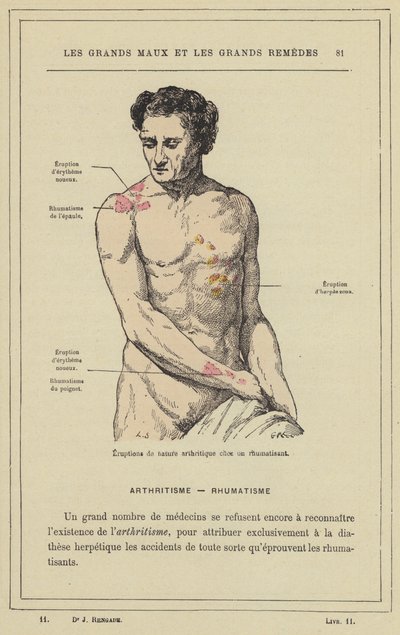 Éruptions de nature arthritique chez un rhumatisant - French School