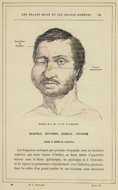 Érysipèle de la face en voie de progression - French School