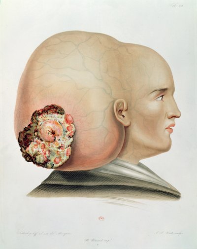 Fongus de la dure-mère, tiré de Selecta Praxis Medico-Chirurgica par Alexander Auvert, Paris, 1856 - French School