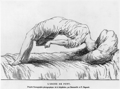 Hystérie et somnambulisme, de Les Maladies Épidémiques de l