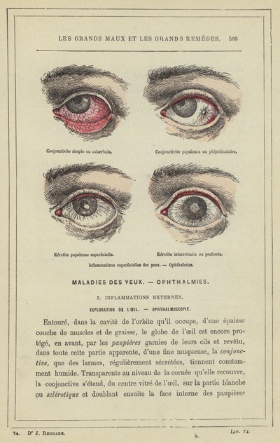 Inflammations superficielles des yeux, Ophthalmies - French School
