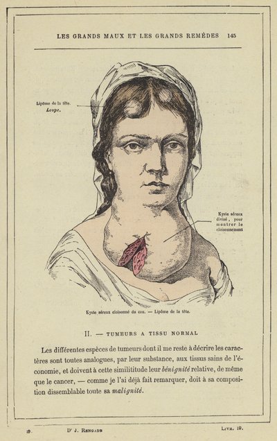 Kyste séreux cloisonné du cou, Lipome de la tête - French School