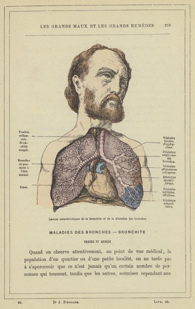 Lésions caractéristiques de la bronchite et de la dilatation des bronches - French School