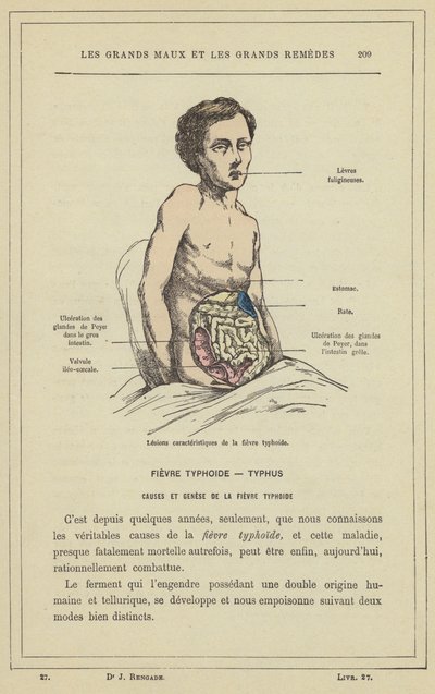 Lésions caractéristiques de la fièvre typhoïde - French School