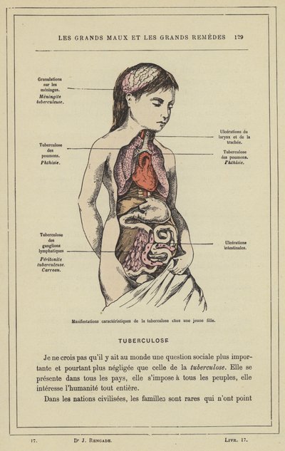 Manifestations caractéristiques de la tuberculose chez une jeune fille - French School