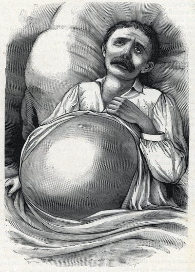 Patient avec cirrhose hépatique avancée (gravure) 1888 - French School