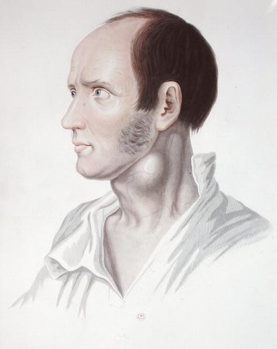 Patient avec un anévrisme, de 