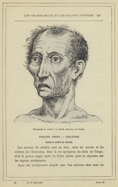 Physionomie du malade à la période asphyxique du choléra - French School