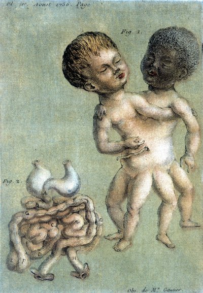 Planche de médecine représentant des frères siamois : un blanc et un noir. illustration de Toussaint (1756) dans "Observations périodiques sur la physique, l