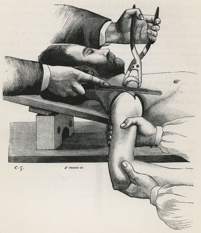 Résection de l