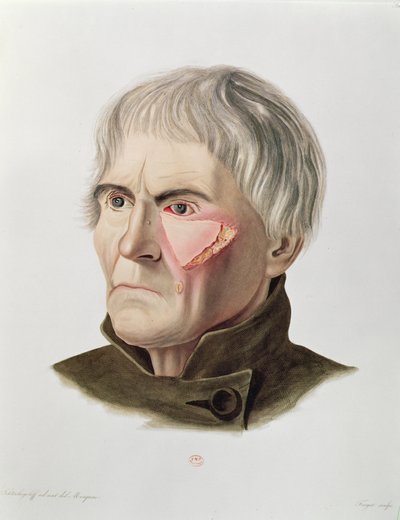 Opération de greffe de peau, tiré de Selecta Praxis Medico-Chirurgica par Alexander Auvert, Paris, 1856 - French School
