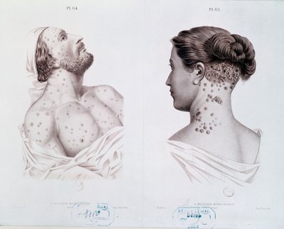 Symptômes de la syphilis chez les hommes et les femmes, d