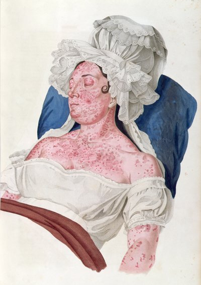 Femme atteinte de scarlatine, d
