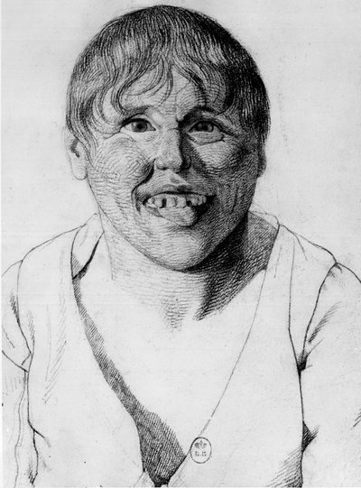 Crétin, - dans « Étude de la physionomie des aliénés », dessin par Gabriel - Georges Francois Gabriel
