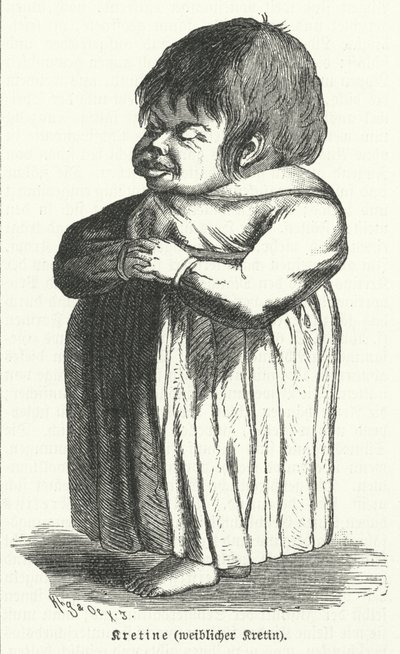 Crétin, femme souffrant de carence congénitale en iode (gravure) - German School
