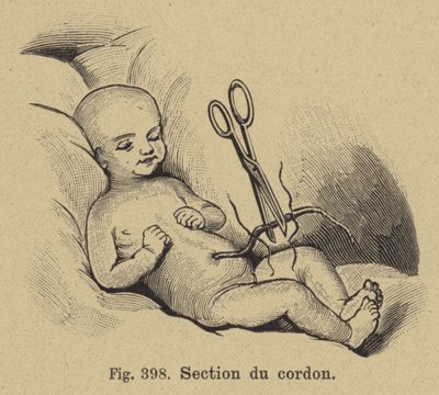 Coupe du cordon ombilical d