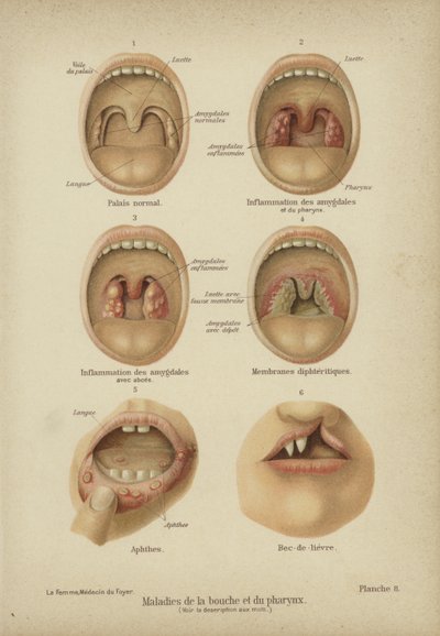Maladies et troubles de la bouche et de la gorge - German School