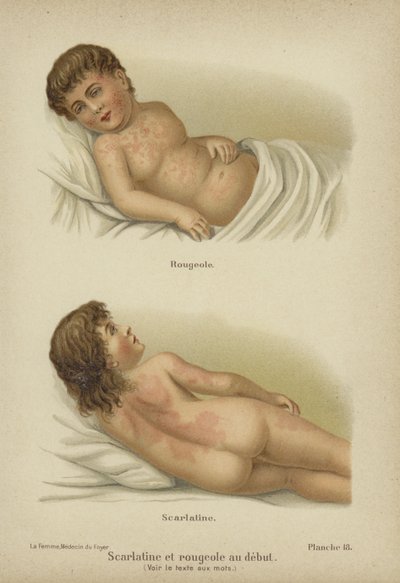 Premiers symptômes de la rougeole et de la scarlatine - German School