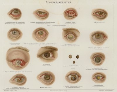 Troubles oculaires - German School