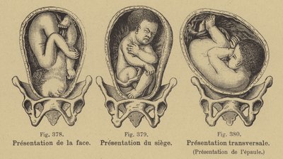 Malprésentation des bébés dans l