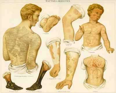 Troubles cutanés, c.1890 - German School