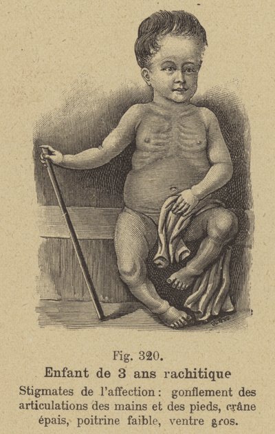 Enfant de trois ans souffrant de rachitisme - German School