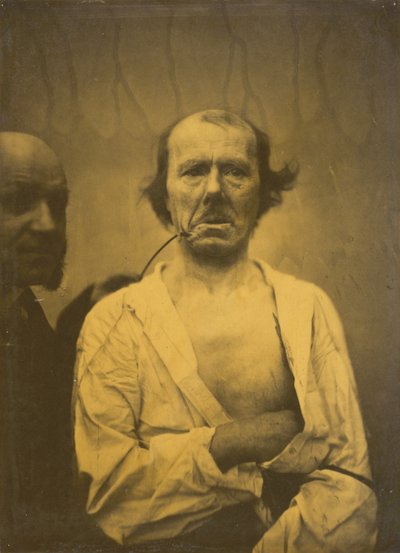 Une expression détendue (gauche); Dégoût (droite) - Guillaume Benjamin Amant Duchenne