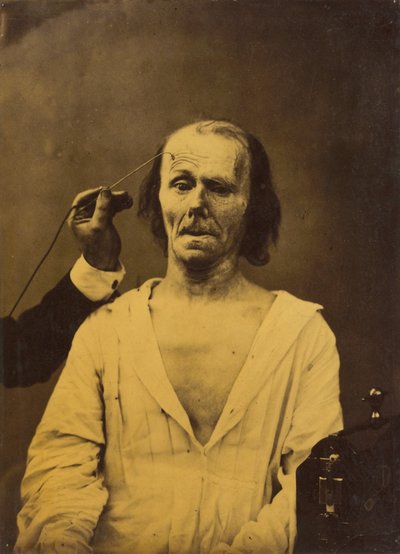 Visage détendu (gauche); Attention profonde (droite) - Guillaume Benjamin Amant Duchenne
