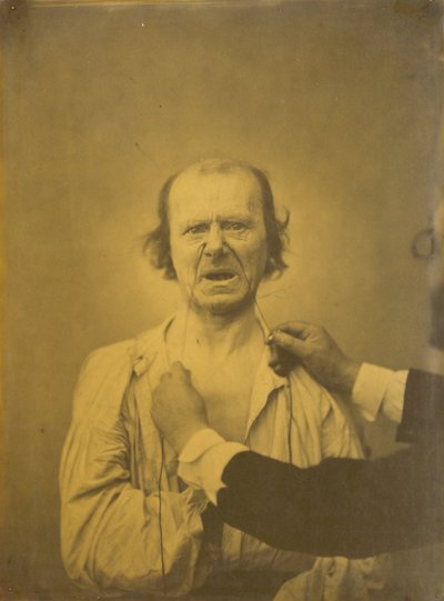 Mécontentement, mauvaise humeur - Guillaume Benjamin Amant Duchenne