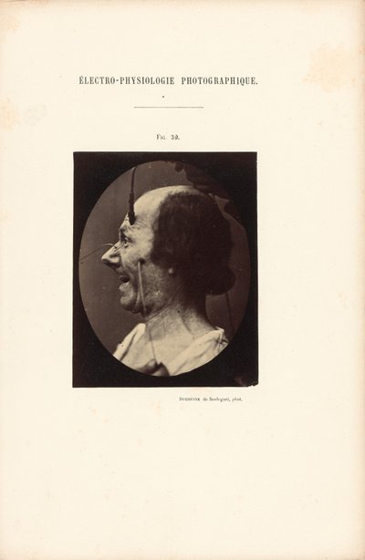 Électro-Physiologie Photographique, Figure 39 - Guillaume Benjamin Duchenne