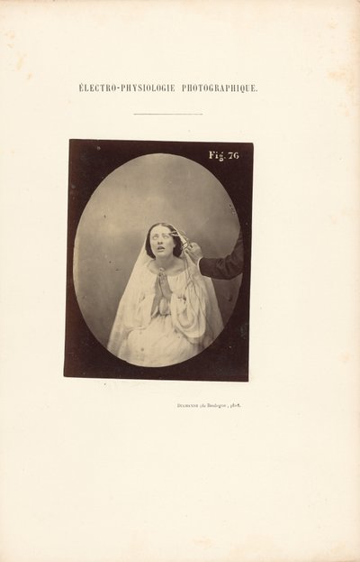Électro-Physiologie Photographique, Figure 76 - Guillaume Benjamin Duchenne