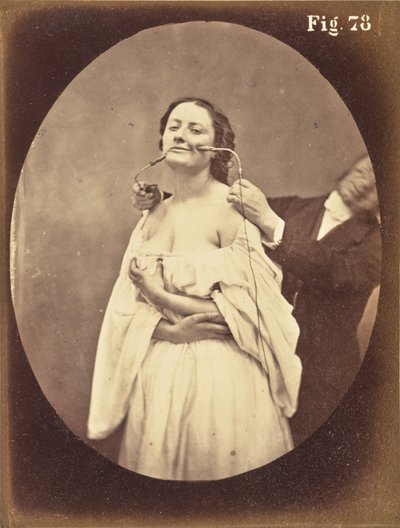 Fig. 78 - Guillaume Benjamin Duchenne