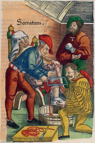Une amputation, illustration du 