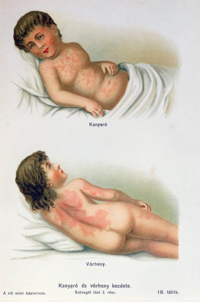 Rougeole et scarlatine, d