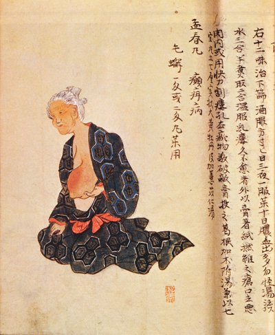 Le premier traitement chirurgical du cancer du sein sous anesthésie générale par Seishu Hanaoka en 1804 - Japanese School