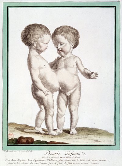 Enfants siamois - dans « Les déviations de la nature » par Régnault - Jean Baptiste Regnault
