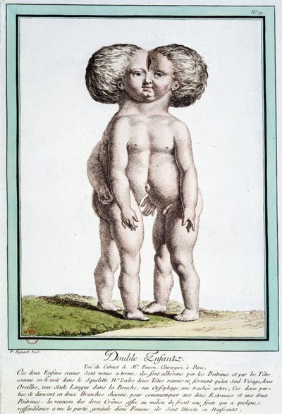Enfants siamois - dans « Les déviations de la nature » par Régnault - Jean Baptiste Regnault