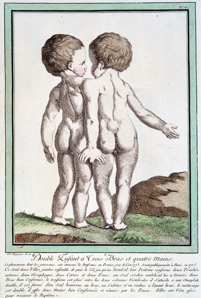 Enfants siamois - dans "Les déviations de la nature" par Régnault - Jean Baptiste Regnault