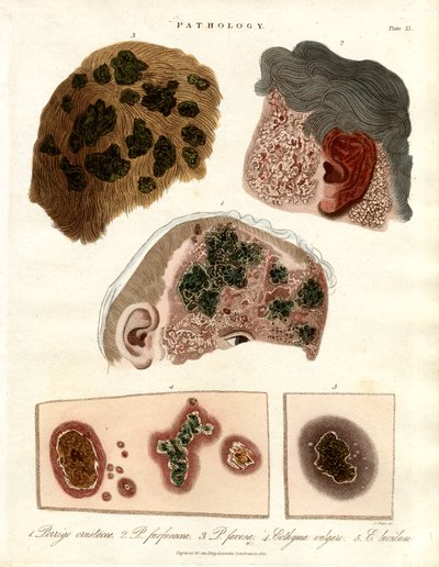 Modifications pathologiques de la peau : Porriga et Ecthyma - John Pass