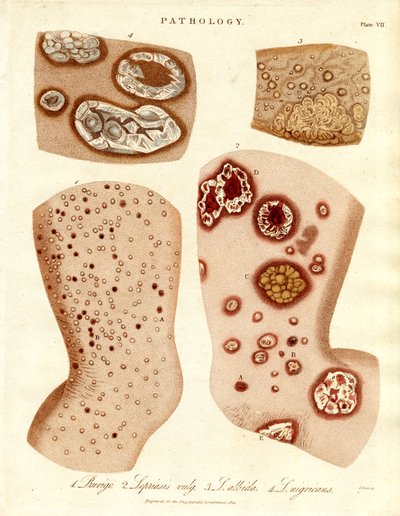 Affections cutanées pathologiques : Schurigie ; peau lépreuse ; pallada et impétigo - John Pass