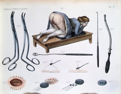 Opération sur une fistule vésico-vaginale, planche de 